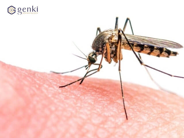 Đừng bỏ qua 5 cách trị sẹo muỗi đốt lâu năm không để lại thâm có thể thực hiện ngay tại nhà