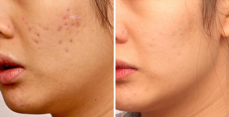 3 nguyên nhân phổ biến gây sẹo lõm trên da mặt