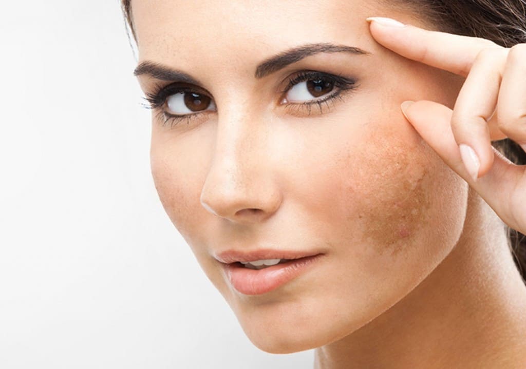 Phương pháp trị nám bằng Laser không những loại bỏ được các nguyên nhân gây ra nám ở bên trong bề mặt da mà còn giúp cho chị em có được làm da khỏe mạnh và sáng đẹp hơn lúc ban đầu.