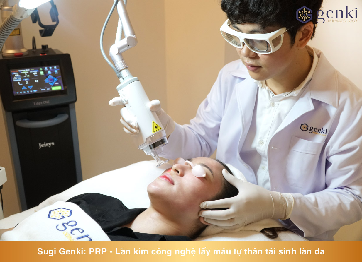 Phương pháp Lăn kim PRP điều trị sẹo rỗ