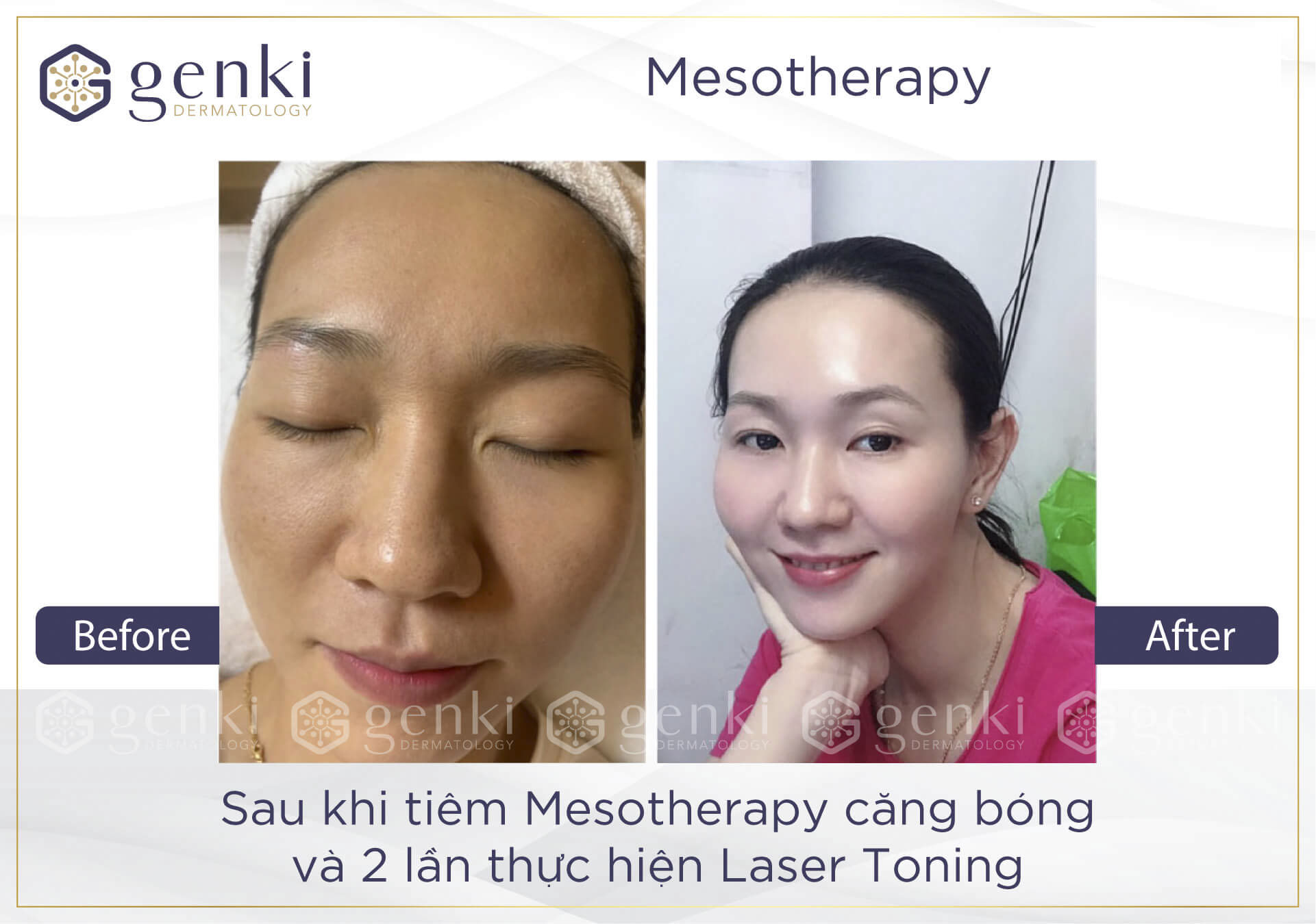 Sau khi thực hiện căng bóng da mặt bằng Mesotherapy bạn cần chú ý điều gì?