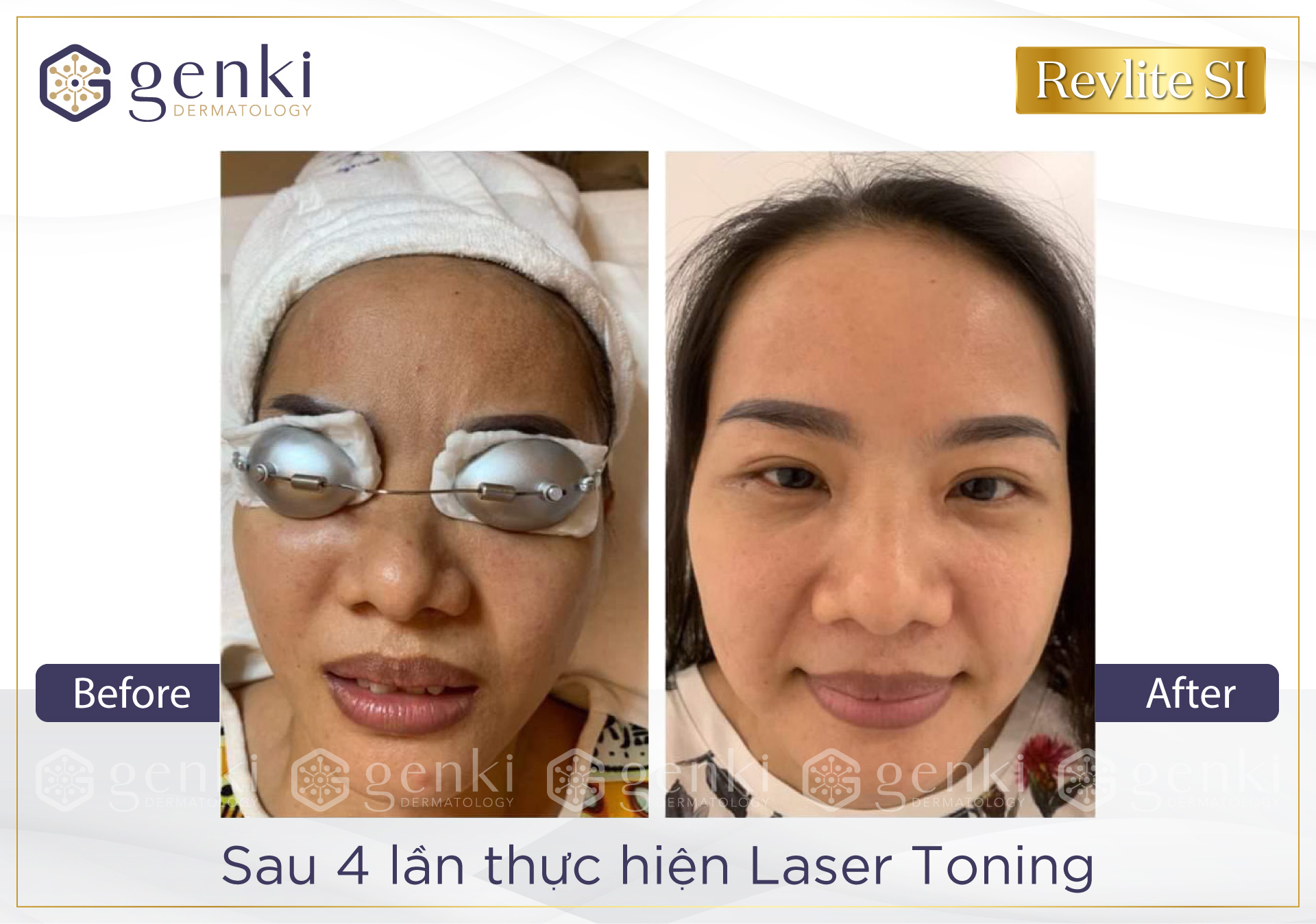 Trẻ hóa da bằng Laser Revlite SI có những ưu điểm nào khiến phái đẹp trầm trồ?