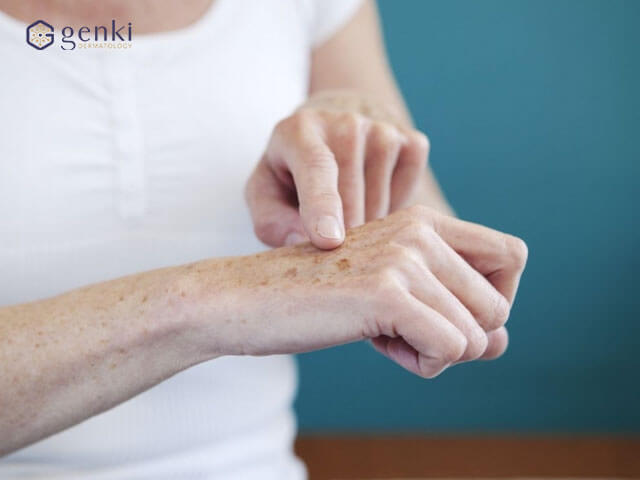 Giúp bạn phân biệt các dạng nám da trên cánh tay