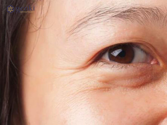 Vì sao vùng da mắt dễ bị xấu và lão hóa nhất?