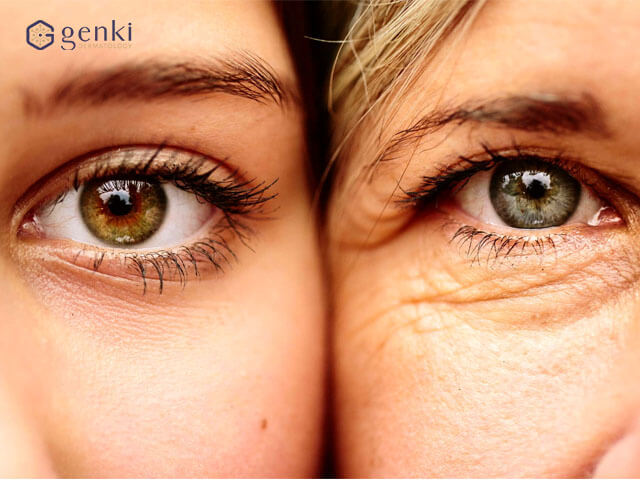 Công nghệ Thermage FLX xóa nhăn vùng da mắt cực hiệu quả