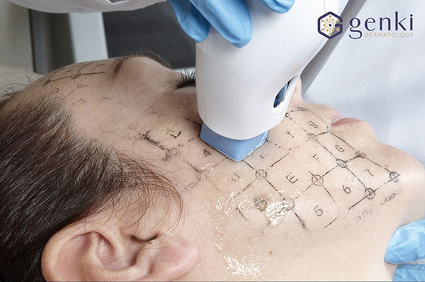 công nghệ trẻ hóa da thermage