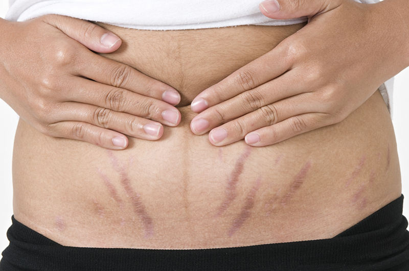 Tăng cân đột ngột và mang thai là nguyên nhân chủ yếu gây rạn da