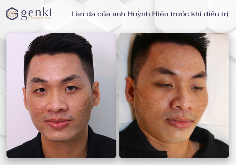 Làn da của anh Huỳnh Hiếu trước khi điều trị với những vết sẹo rỗ sâu, phủ khắp hai má cùng tình trạng mụn sưng viêm