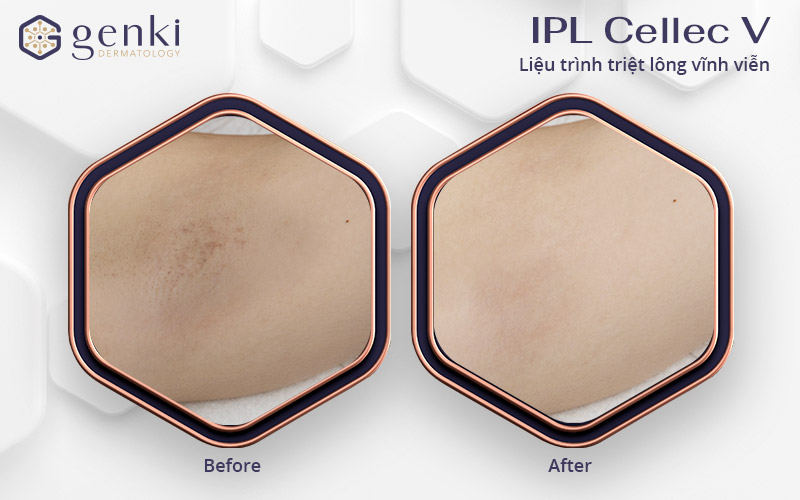 công nghệ triệt lông vĩnh viễn IPL Cellec V