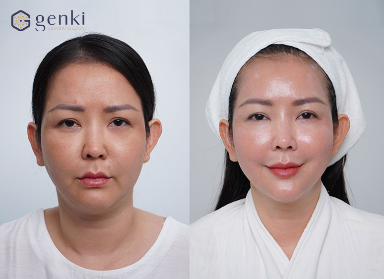 Hình ảnh trước và sau khi thực hiện Thermage FLX, kết quả thay đổi tùy cơ địa
