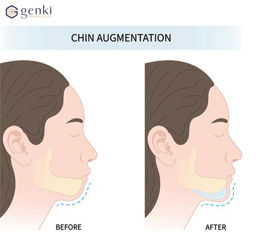 Hình minh họa ứng dụng filler làm đầy tạo đường nét vùng cằm