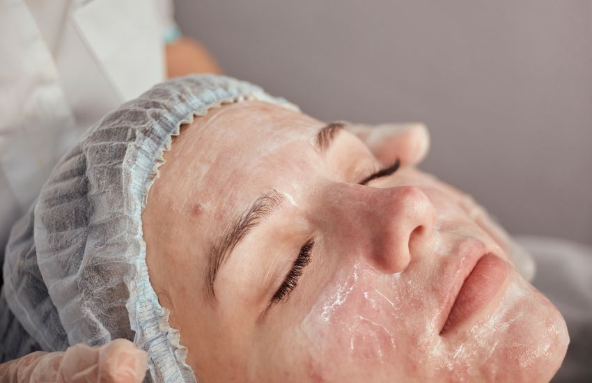 liệu trình peel da trị mụn