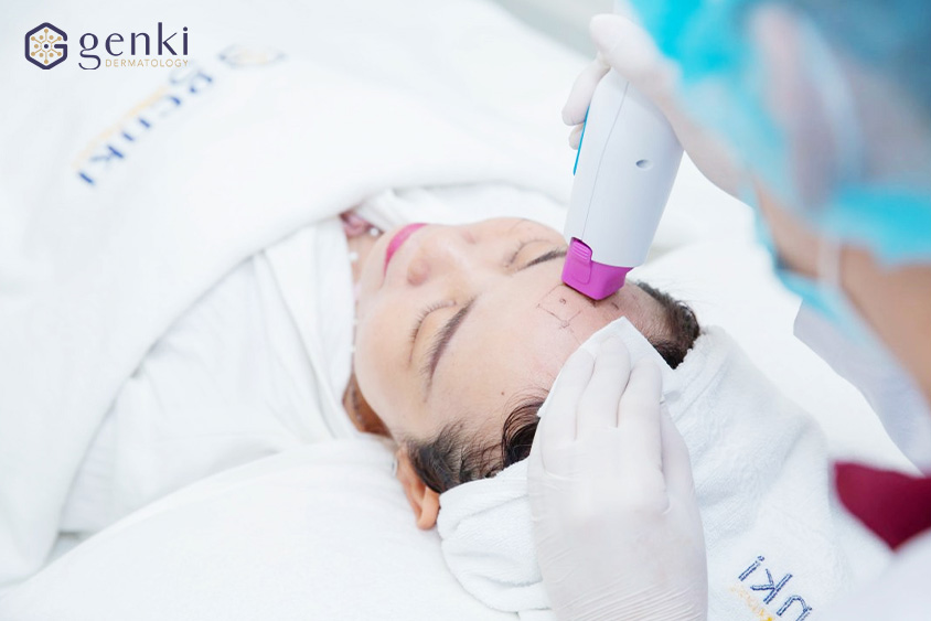 Chuyên viên thực hiện Thermage FLX vùng trán theo lưới định vị cho khách hàng
