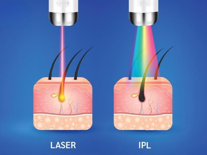 Phương pháp triệt lông nách bằng xung cường độ cao IPL