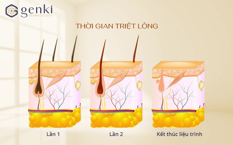 Quy trình triệt lông nách vĩnh viễn chuẩn y khoa tại Genki Derma